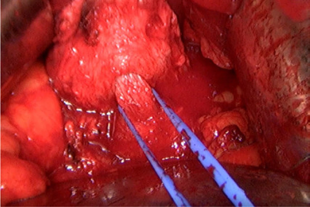 Hrdlo je kompletně uvolněno a zavěšeno na
tkanici<br>
Fig. 3. The bladder neck is dissected completely and
fixed with a tape