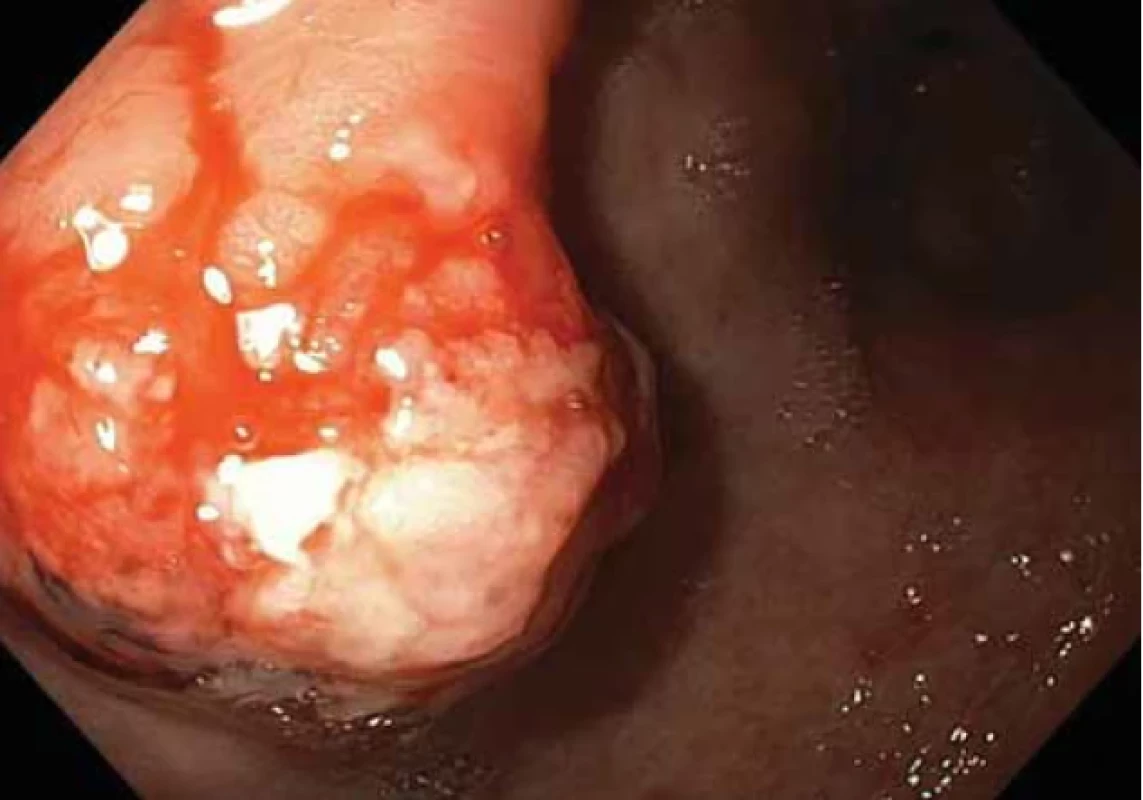 Polypózní léze na přední stěně na přechodu těla a antra žaludku – druhá kontrolní gastroskopie.</br> Fig. 5. Polyposis lesion on the front wall at the junction of the body and antrum of the stomach – the second control gastroscopy.