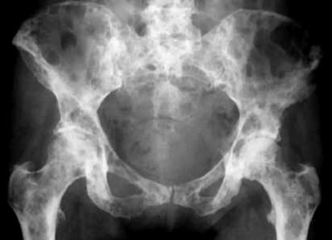 Vyšetrenie zobrazovacími metódami:
RTG-nález osteolytických metastáz
v oblasti panvy. Archív Onkologického ústavu
sv. Alžbety, s.r.o., Bratislava