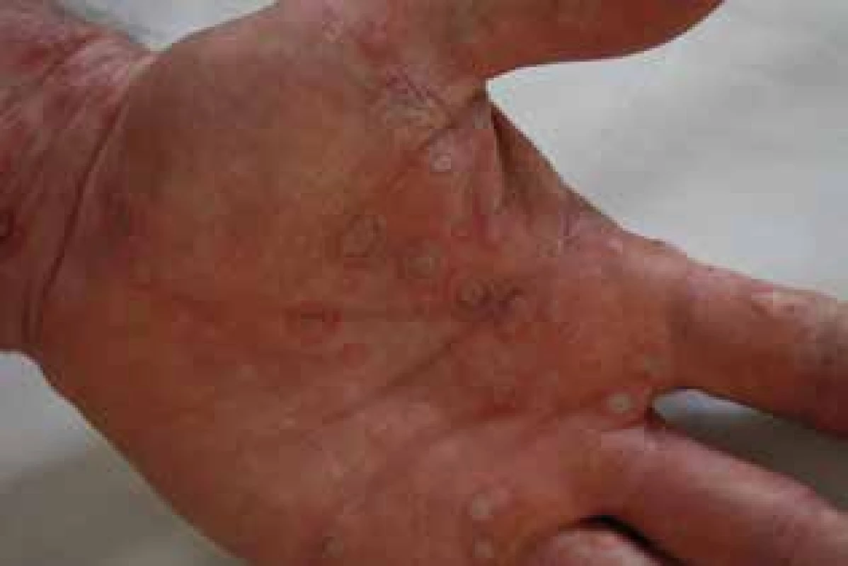 Erythema exsudativum multiforme po meloxikame