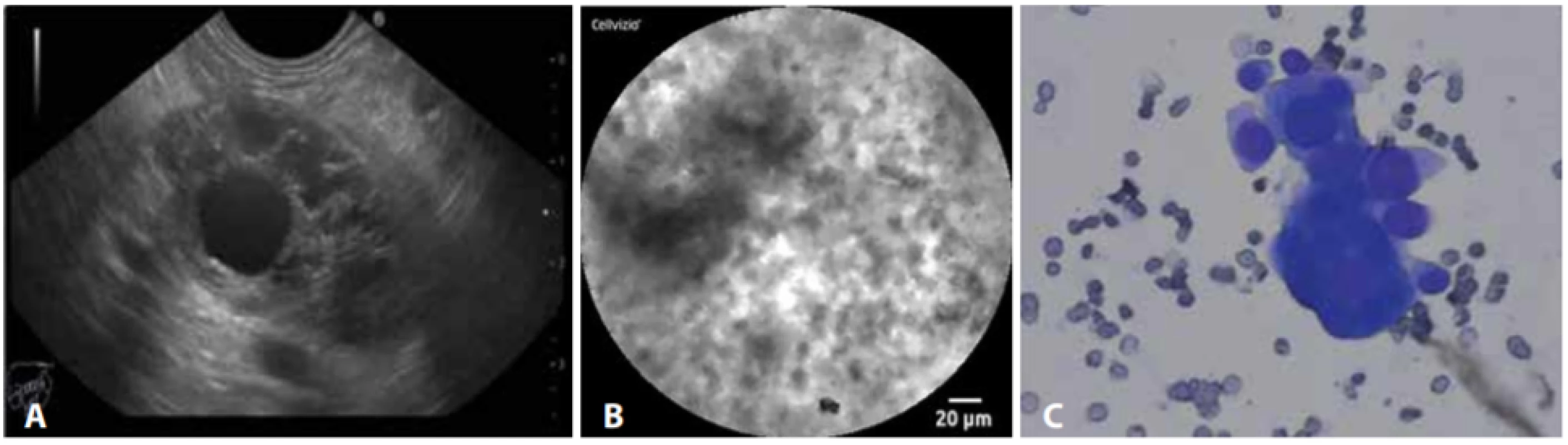 EUS (A), nCLE (B) a cytologie (C) adenokarcinomu slinivky
nCLE s typickým nálezem tmavých shluků buněk. Pacient podstoupil resekci (tumor 41×28×24 mm, pozitivní uzliny, nízce diferencovaný adenokarcinom, cystická komponenta v resekátu popsána nebyla).<br>
Fig. 2: EUS (A), nCLE (B) a cytology (C) of adenocarcinoma of the pancreas
nCLE with typical black neoplastic cell clusters. The patient underwent surgery (tumour 41×28×24 mm, positive lymph nodes,
poorly differentiated adenocarcinoma; no cystic component was described by the pathologist).