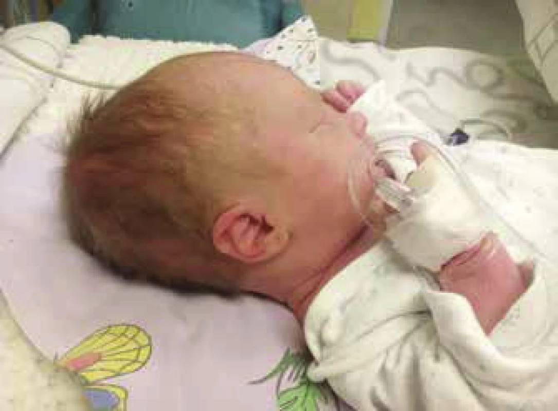 Hydrocephalus of inflammatory (toxoplasmic) etiology –
upon visual inspection evident larger head circumference (38.5 cm).