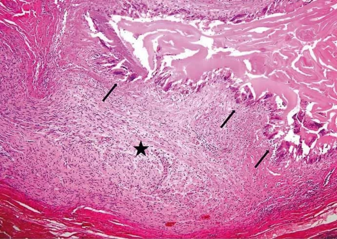 Perineurální šíření echinokoka. Hvězdička v nervu, šipky ukazují na struktury echinokoka (barvení hematoxylin-eozinem, původní zvětšení 100×). (Zdroj: MUDr. Hana Skopcová).<br>
Fig. 4. Perineural spread of echinococcus. The star is in the nerve; arrows show the echinococcal structures (hematoxylin-eosin staining, original magnifi cation ×100). (Author: MUDr. Hana Skopcová).