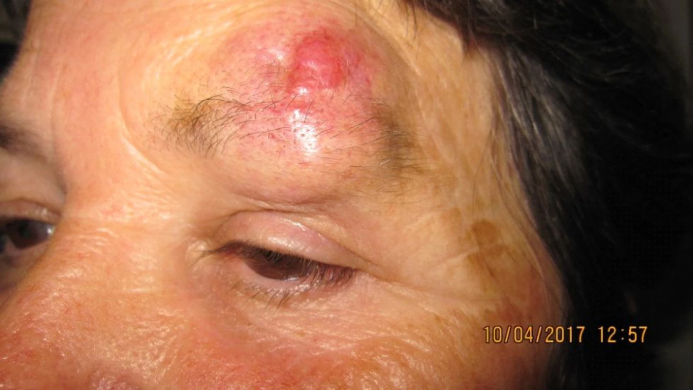 Patient 2 – detail of lesion in part of upper eyelid and
supercilium in April 2017