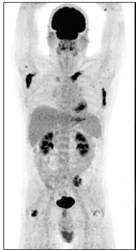 (vlevo) Sumarizace nálezů
<sup>18</sup>F-FDG PET/CT vyšetření
u pacienta č. 5. Černobílá
MIP projekce ukazuje rozsah
snímání, odráží i rozsah kostního
postižení ve snímaném
rozsahu. Fúzované obrazy pak
ukazují detaily hypofyzárního,
paranasálního i kostního postižení.