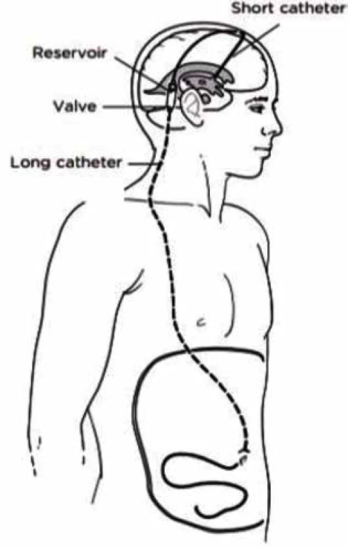 Schematické znázornění ventrikuloperitoneální
drenáže<br>
Fig. 3: Schema showing ventriculoperitoneal shunt