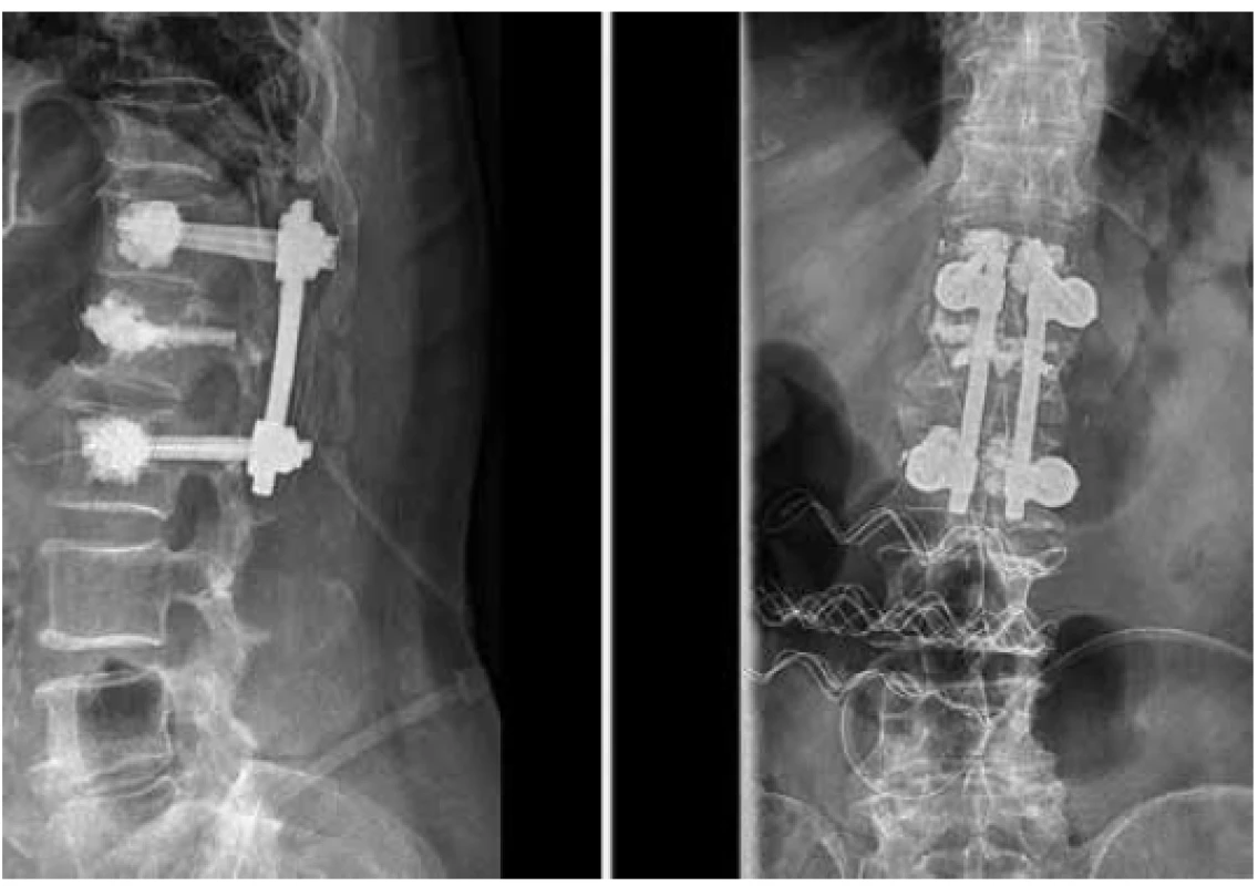Po provedení krátké zadní transpedikulární fixace
s fenestrovanými šrouby Th12-L2 a vertebroplastikou
těla L1 (boční a AP projekce)<br>
Fig. 2. Condition after short segment transpedicular fenestrated
screw fixation Th12-L2 with vertebroplasty L1
(lateral view and AP view)