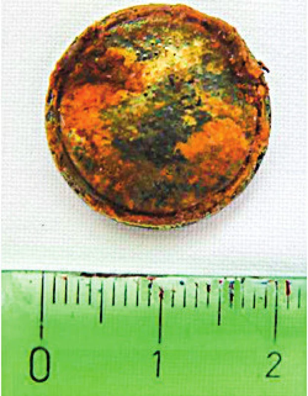 Baterie po odstranění z jícnu. <br><b>Fig. 3.</b> Battery after removal from esophagus.
