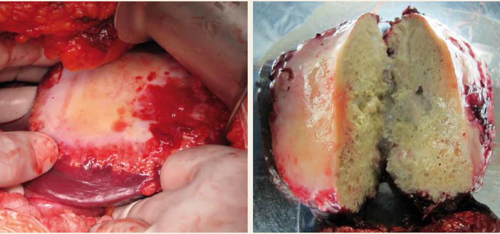 Parazitární cysta v levém laloku jater; peroperační nález a resekovaná cysta.<br>
Fig. 3. Parasitic cyst of the left liver lobe; intraoperative finding and resected cyst