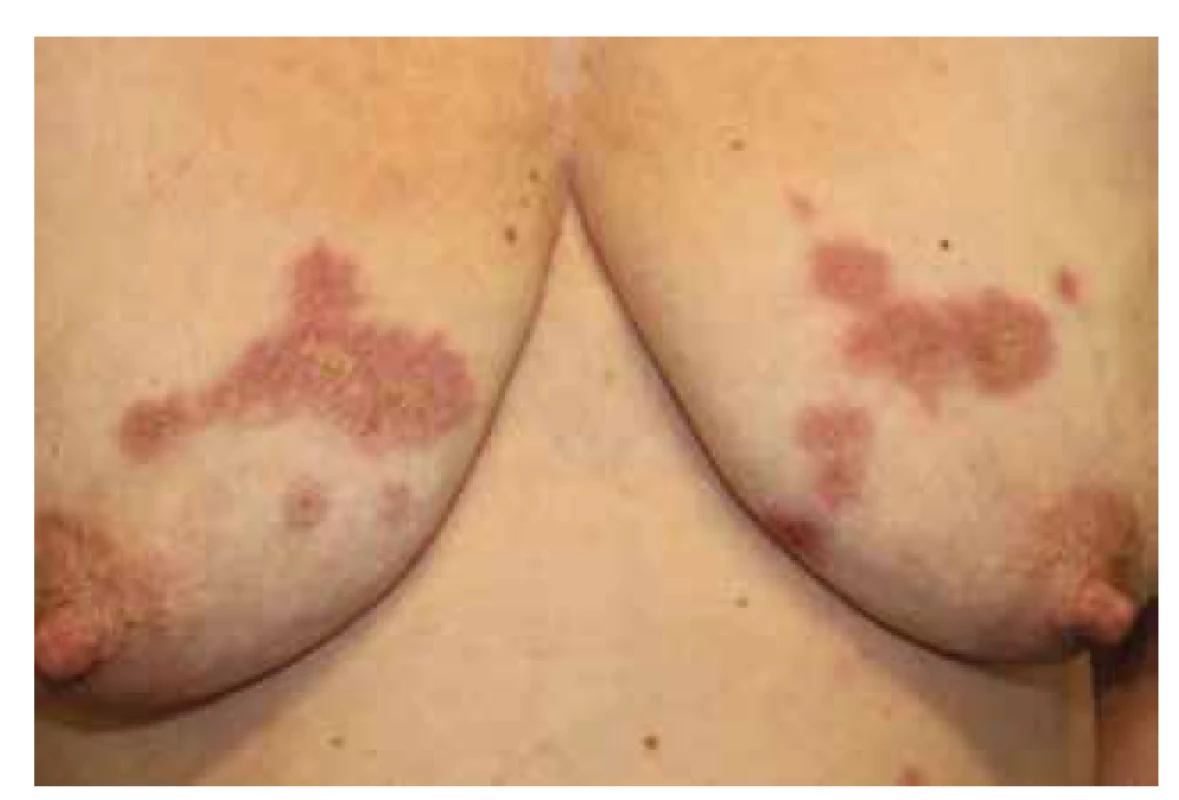 Necrobiosis lipoidica na trupu