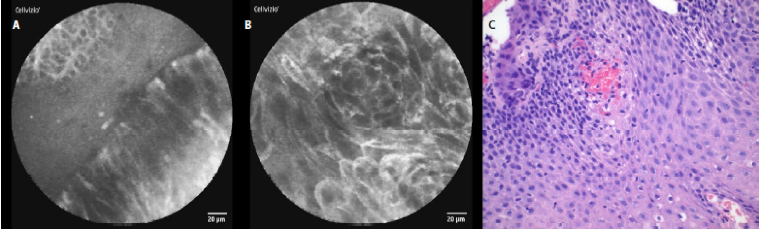 pCLE view of esophagitis: a – columnar cells, hyperemia and inflammatory cells (area of gastroesophageal junction), b – squamous epithelium, stromal papillae with hyperemia; c – histopathology examination: mixed acute and chronic inflammatory cells in the epithelium, basal cell hyperplasia, elongation and hyperemia of the lamina propria papillae, haematoxylin-eosin staining 40×