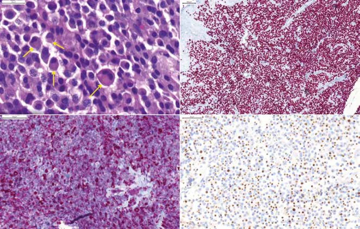 <b>(A)</b> „Sparsely granulated“ somatotropný makroadenóm u 78-ročnej ženy, tzv. fibrózne telieska sú viditeľné v HE farbení ako guľaté prejasnenie
cytoplazmy (šípky), HE 400x. <b>(B)</b> Expresia transkripčného faktora Pit-1, 200x. <b>(C)</b> Variabilná expresia GH, 200x. <b>(D)</b> „fibrous bodies“ vo farbení
CAM 5.2.