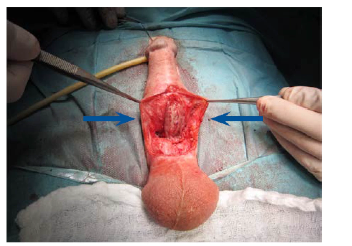Fixace bukálního štěpu dle Asopy dorzálně,
okraje uretry před suturou a tubulizací<br>
Fig. 17. Fixation of the buccal graft dorsally according to
Asopa; urethral edges prior to suturing and tubularization