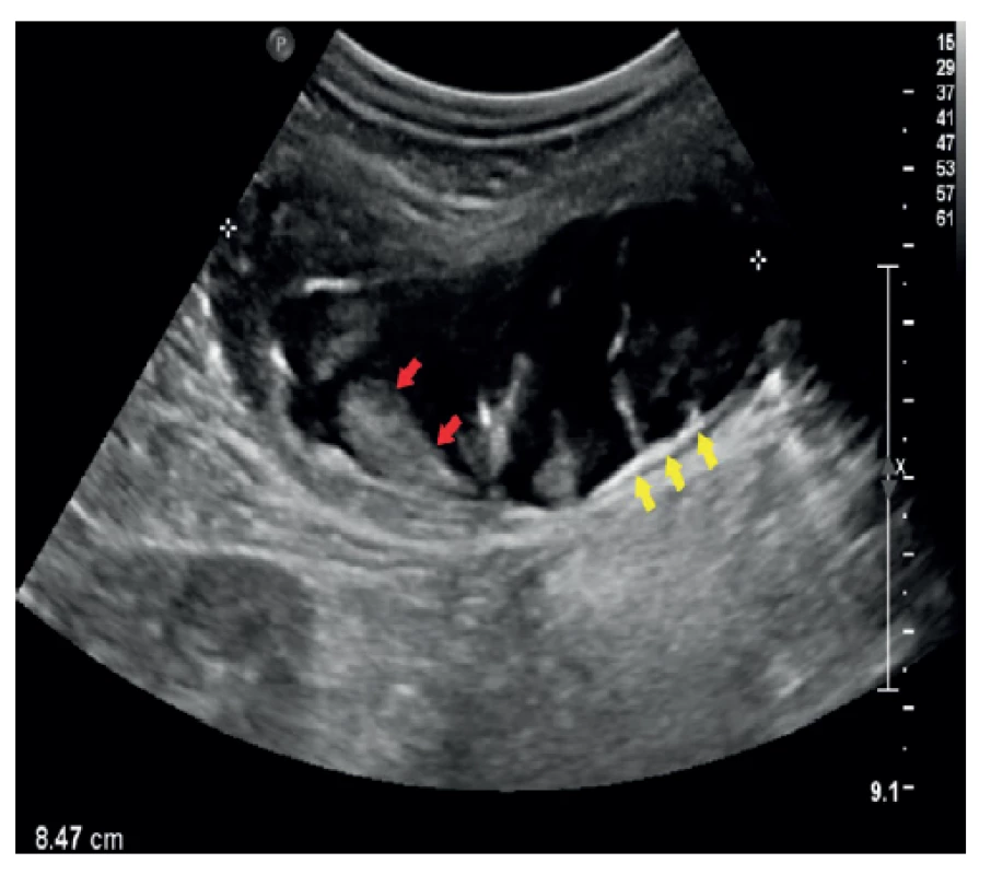 UZ obraz mukokély apendixu – longitudinálně<br>
Sonografie břicha stejného pacienta. V oblasti céka tubulární,
převážně anechogenní útvar, který je částečně vyplněn
echogenním obsahem (červené šipky). V dorzální části stěny
patrné echogenní kalcifikace (žluté šipky). Klinika radiologie
a nukleární medicíny FN Brno a LF MU.<br>
Fig. 2: Ultrasound image of appendiceal mucocele – longitudinal
projection<br>
Sonography of the abdomen of the same patient. A tubular,
mostly anechogenic formation is present in the area of the
cecum, which is partially filled with echogenic content (red
arrows). Echogenic calcifications (yellow arows) are visible
in the dorsal part of the wall. Department of Radiology and
Nuclear Medicine, University Hospital Brno, Faculty of Medicine,
Masaryk University.