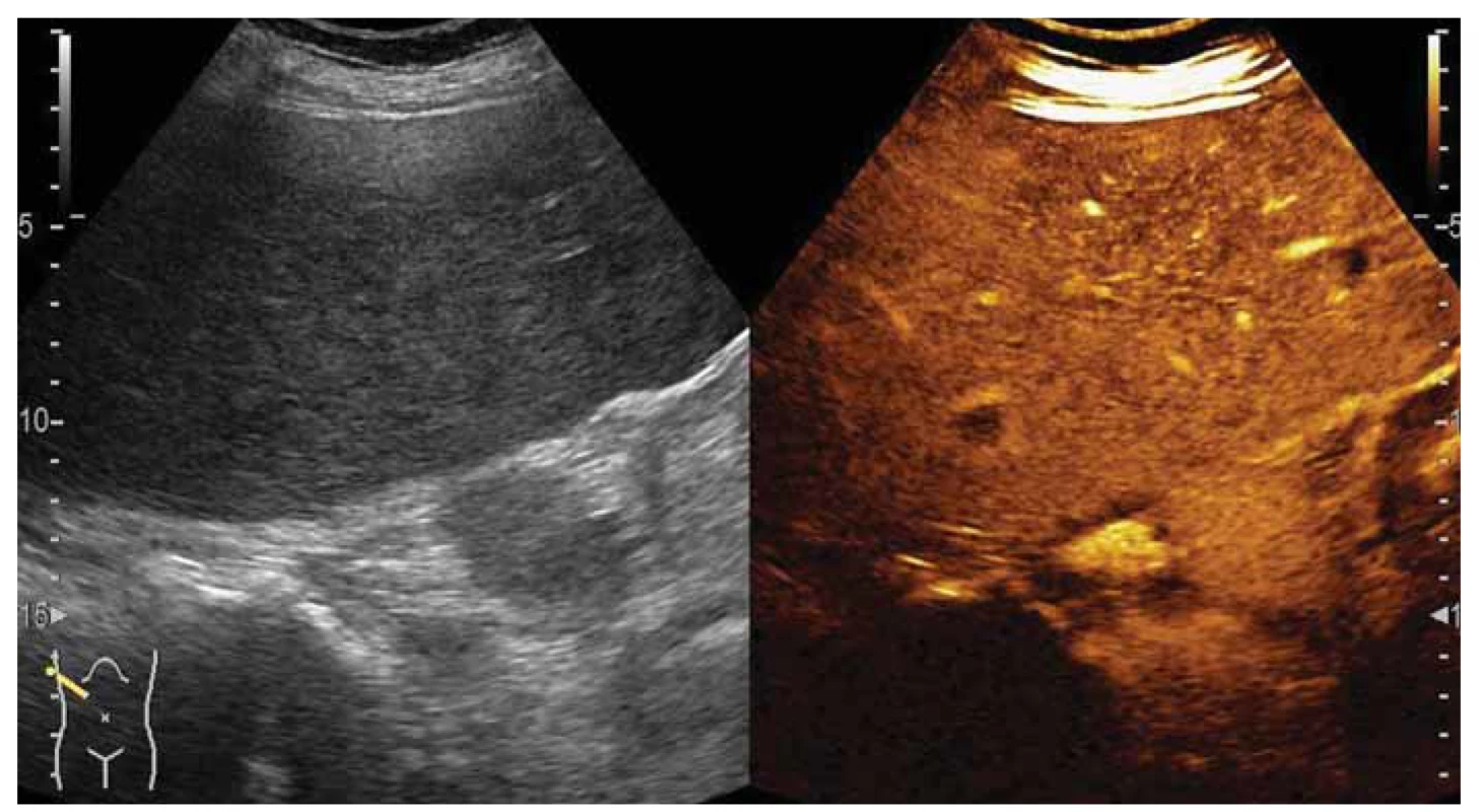 Kontrastná ultrasonografia – pohľad na pravý lalok z interkostálneho prístupu, vidieť dve ložiská s wash-out
vo venóznej fáze.<br>
Fig. 4. Contrast-enhanced ultrasonography – the view of the right lobe from an intercostal approach, two lesions with
washout in the venous phase.