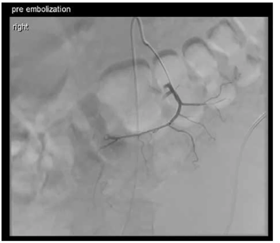 Stav před embolizací tepen zásobujících tumorózní
infiltrát<br>
Fig. 4. Pre-embolisation visualisation of tumour arteries