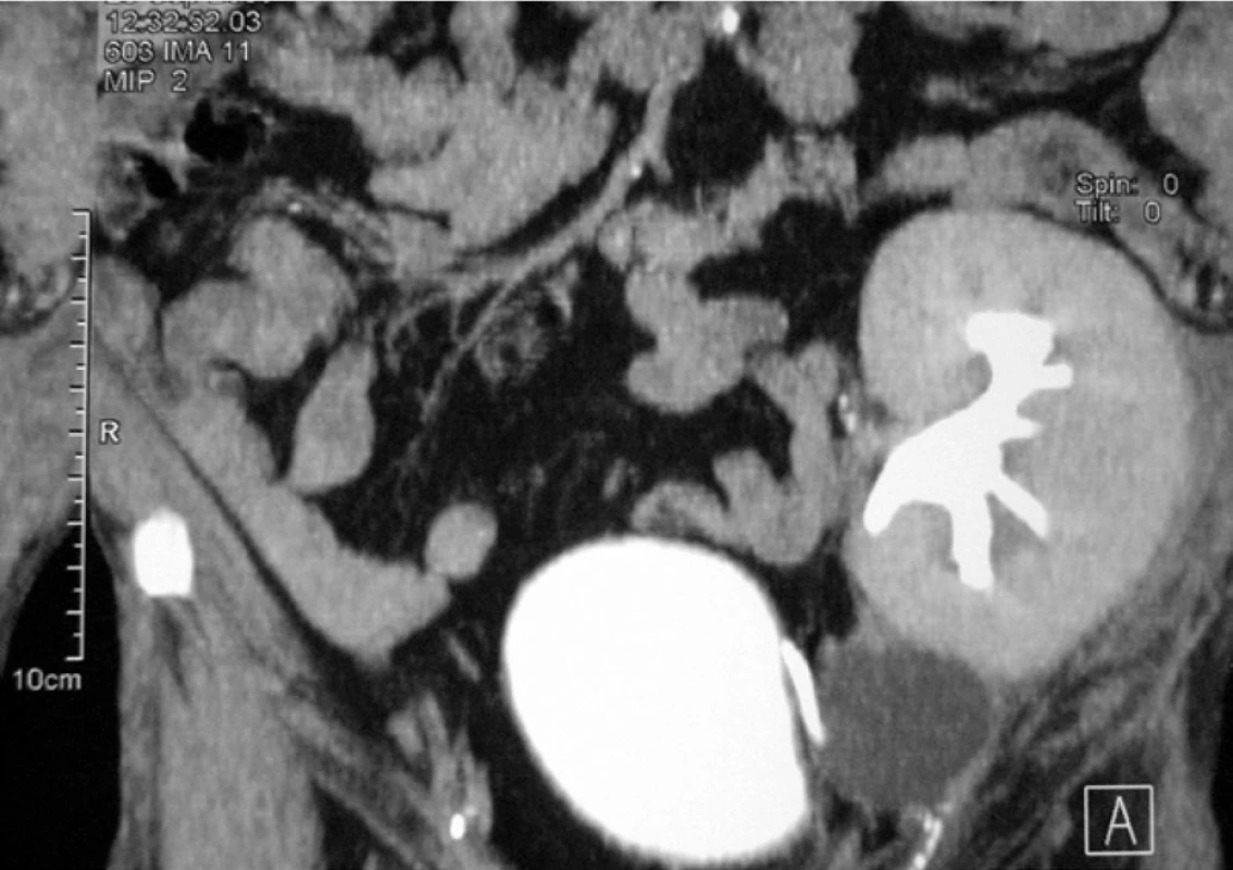 Malá lymfokela pri dolnom póle transplantovanej obličky<br>
Fig. 2. A small lymphocele under the lower pole of the transplanted kidney