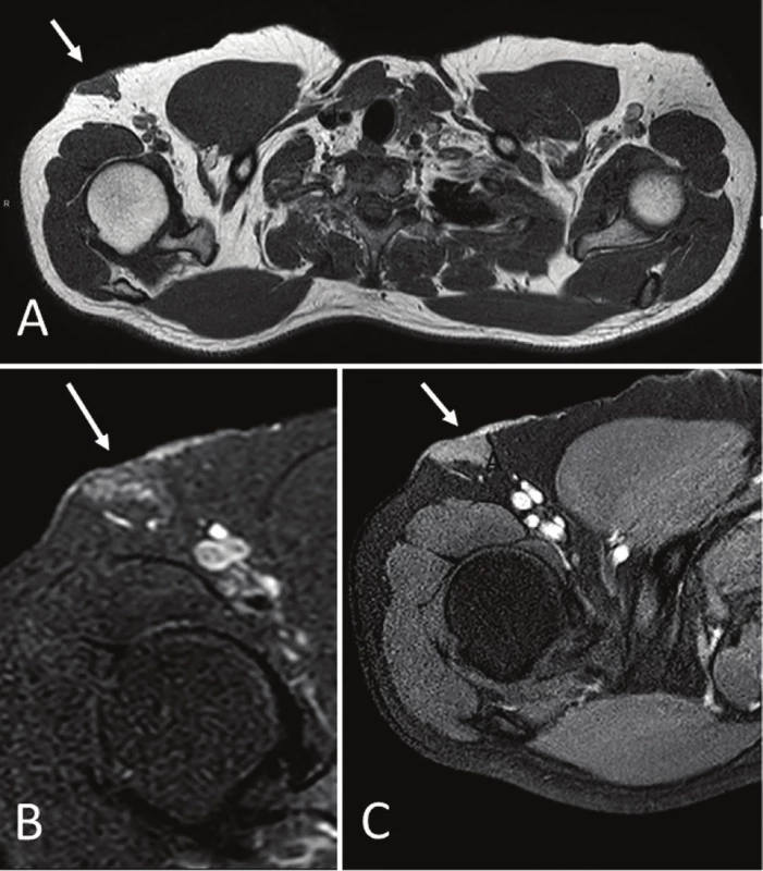 Magnetic resonance imaging (MRI). Axial T1-weighed (A), DP-weighed
fat-suppressed (B), and T1-weighed fat suppressed gadolinium enhanced (C).
Images demonstrate a superficial triangular shaped mass (white arrows),
isointense to muscle on T1 with homogeneous contrast enhancement