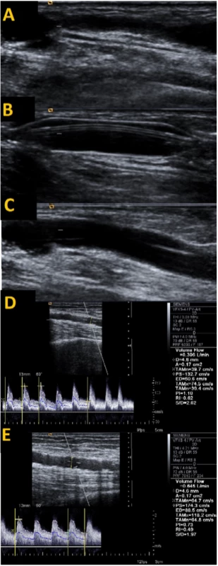Angioplastika odvodnej vény navigovaná pomocou ultrazvuku <br> Zúženie odvodnej vény (A) s následnou angioplastikou tejto oblasti (B) a rozvinutím lumen vény po dilatácii (C). Úprava toku v a. brachialis – po dilatácii došlo k zvýšeniu prietoku z 396 ml/min na 645 ml/min a poklesu odporového indexu (RI) z 0,62 na 0,49