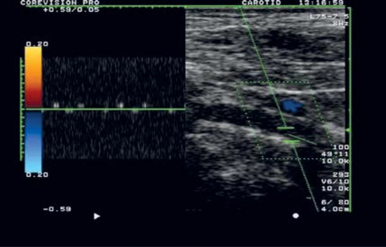 Barevná duplexní
sonografie: čerstvá
okluze a. vertebralis
v segmentu V1