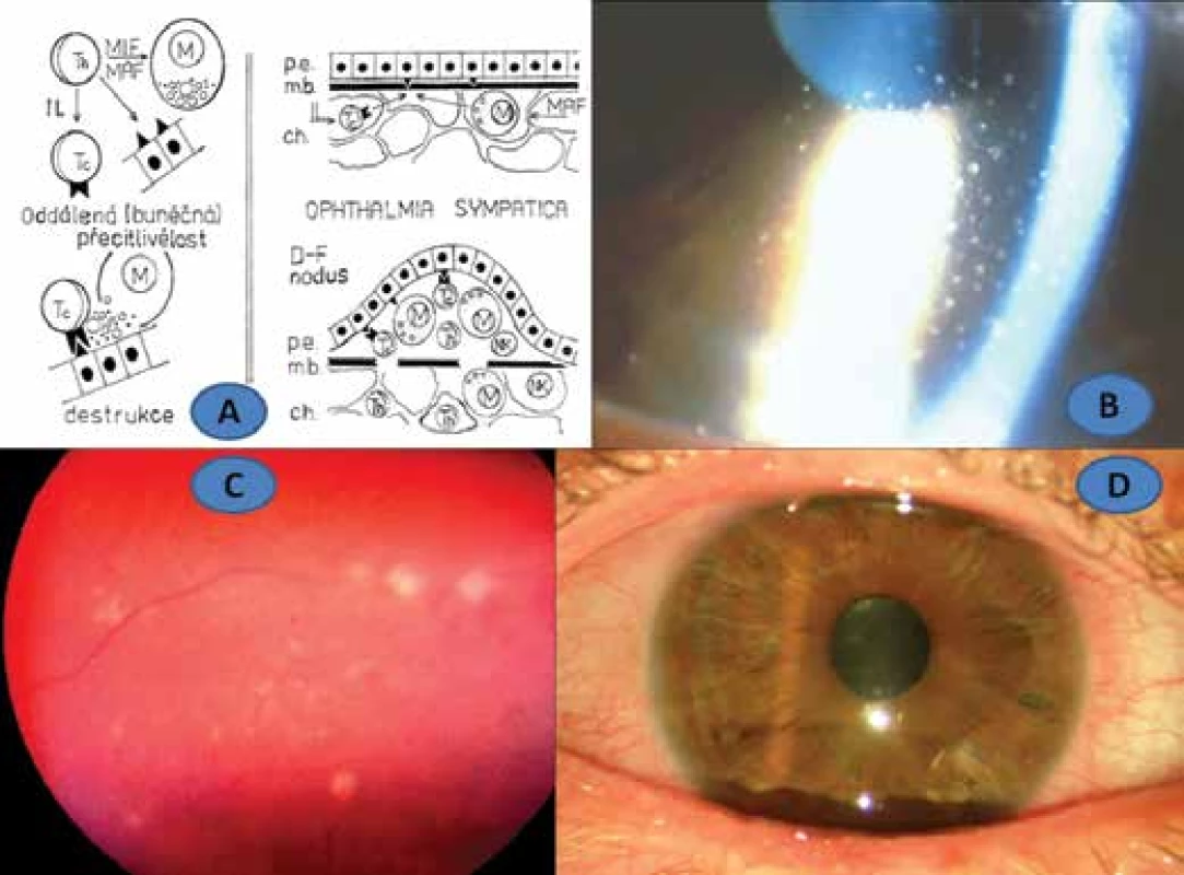 Schema of type IV hypersensitivity (A), patient no. 2: fatty precipitates on corneal
endothelium (B), Dalen-Fuchs nodules in choroid (C), remission of SO with artephakia and
Express shunt (D)