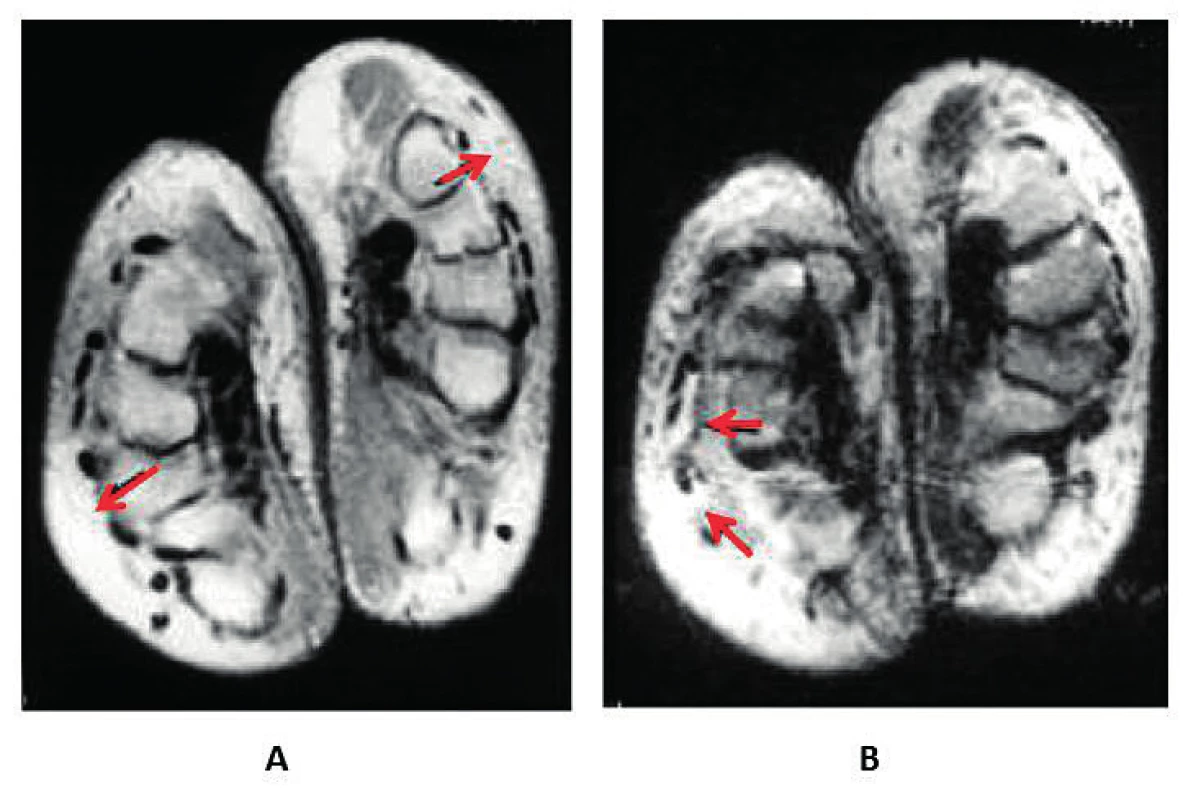 Fenomén boxerské rukavice u syndromu RS3PE. MRI ruky (upraveno podle (19)): A – edém podkoží (šipky) při axiální projekci
protonové denzity, B – tekutina synoviální pochvy šlach extenzorů (šipky) v axiální projekci T2