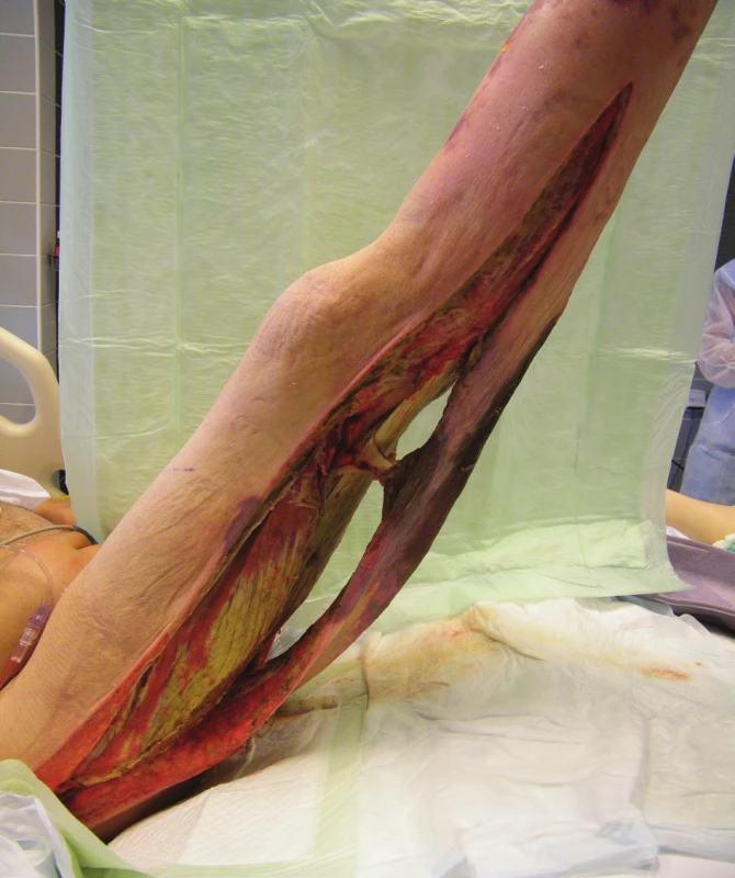 Pravá dolní končetina při převazu – rozsáhlé dermofasciotomie
(19. 6. 2014)<br>
Fig. 2: Right lower extremity during dressing change – extensive
dermofasciotomies