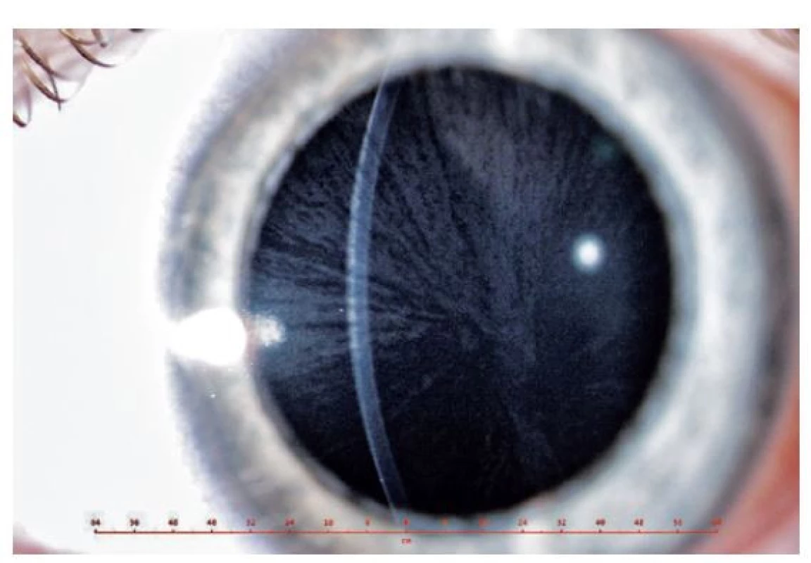 Cornea verticillata mladší sestry pacienta (11 let)