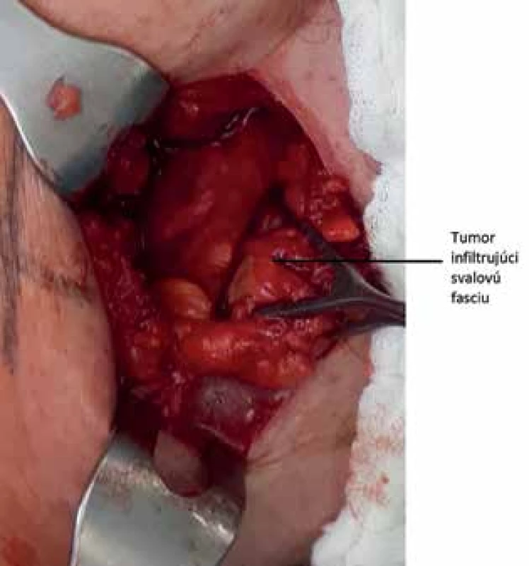 Tumor infiltrujúci svalovú vrstvu brušnej steny <br>
Fig. 2: Tumor infiltrating the muscular layer of the abdominal wall