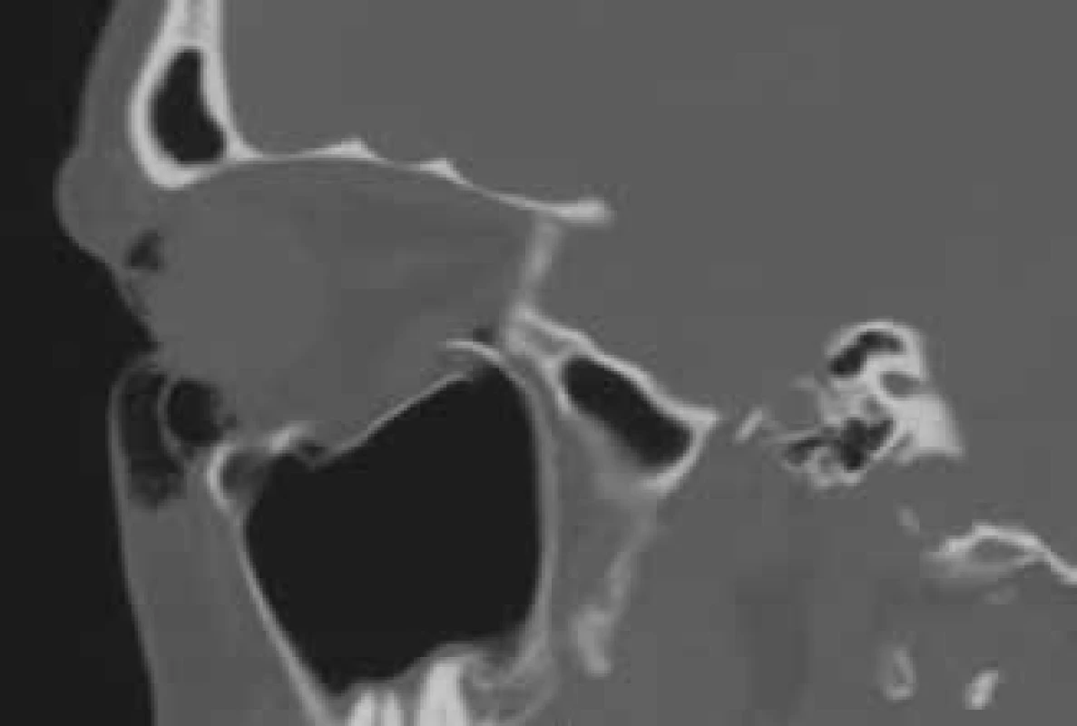  CT examination of fracture of base of orbit, defect was
larger than 50 %, reconstruction of the base of the orbit was
performed by a stomatologist