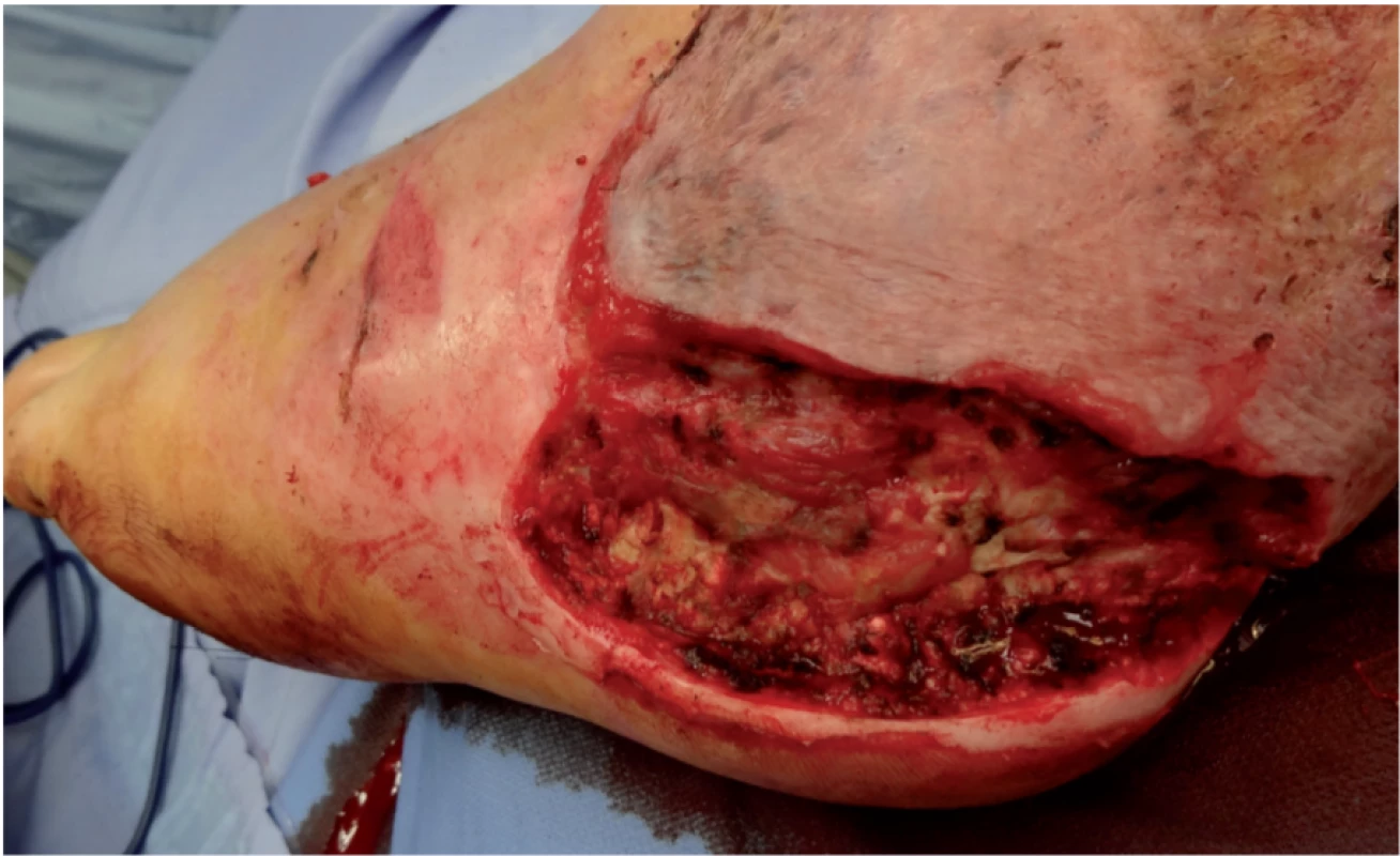 Defect after repeated debridement and necrectomy before final autotransplantation