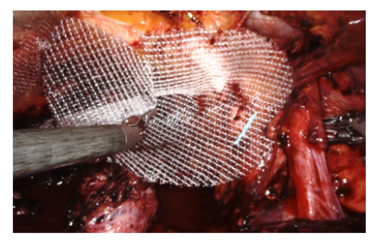 Síťka vpravo ještě před podvlečením pod
semenným provazcem<br>
Fig. 7. Mesh on the right side before placement behind
the seminal cord