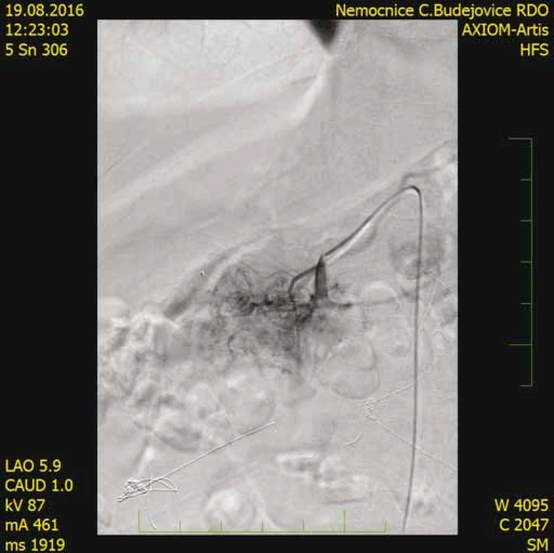 CT angiografia s nálezom patologickej vaskularizácie
v oblasti hlavy pankreasu.<br>
Fig. 9. CT angiography shows pathological vascularisation
in the region of the pancreas head.