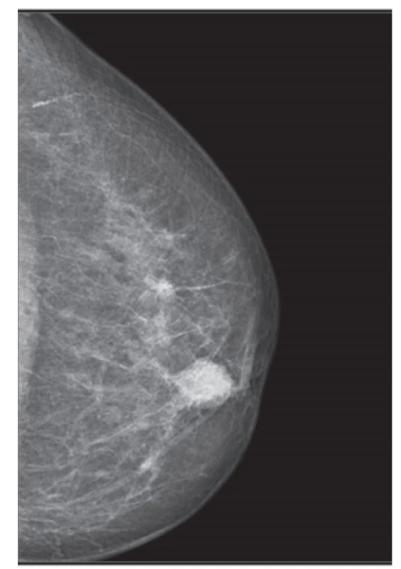  Karcinom prsu u seniorů − mammografie<br>
Fig. 2: Breast carcinoma in elderly patients − mammography