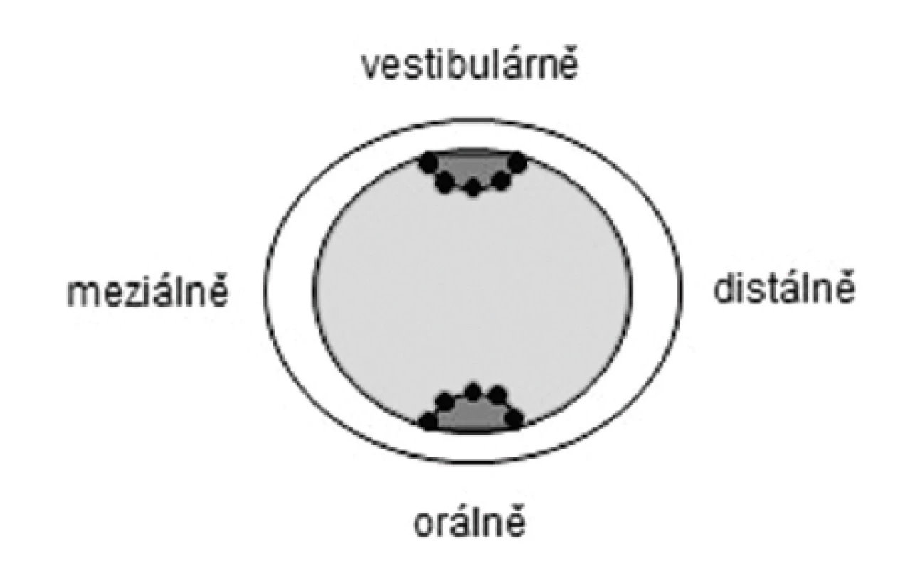 Horizontální řez otiskem. Měřené body (tečky) ve vestibulárních/linguálních slotech; obdobně<br>v aproximálních kavitách (pět bodů v každém pomocném prvku).
Fig. 4
Horizontally cut replica slice. Measuring points (dots) in buccal/lingual grooves and proximal boxes respectively (five points each).