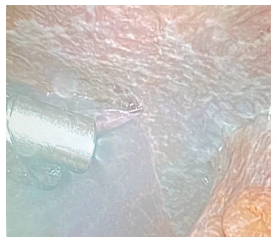 Produkovaný aerosol v průběhu PIPAC<br>
Fig. 7: Aerosol during PIPAC procedure