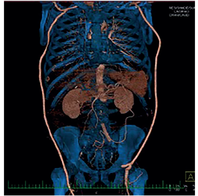 Bilaterální axilofemorální bypass <br>
Fig. 3: Bilateral axilofemoral bypass