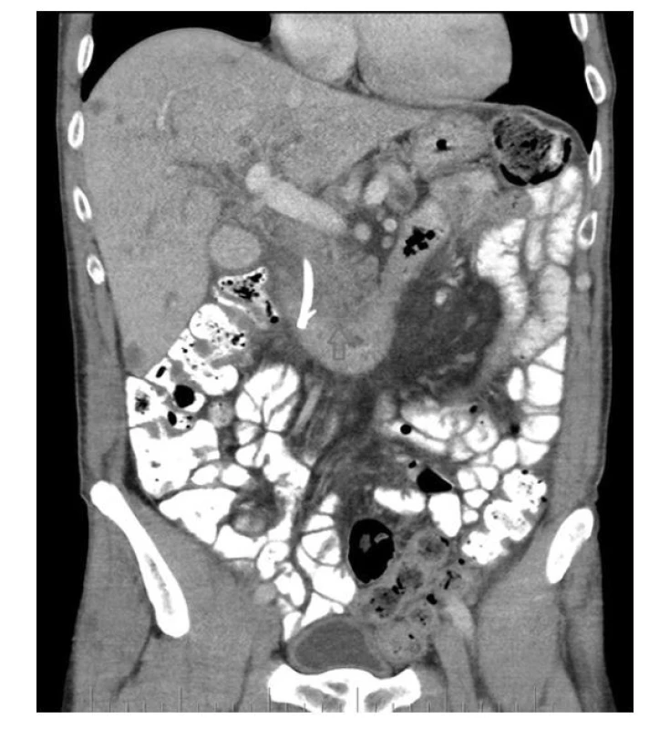 Šipka označuje tumor hlavy pankreatu, vlevo od něj stent, četné
hypodenzity jater jsou metastázy (se souhlasem publikováno z archivu
KZM FNUSA)
