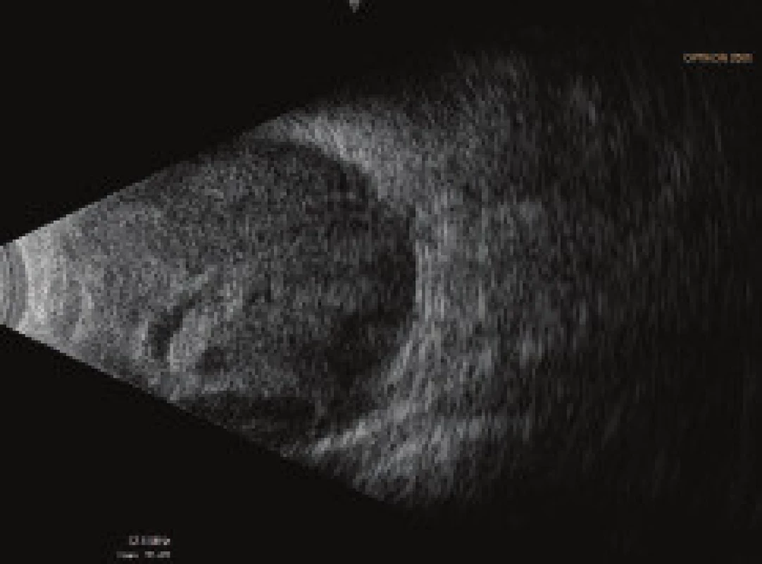 Ultrasound examination (US) of left eyeball on 7th
day after TE of LE