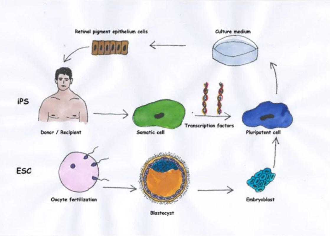  Basic differences between cells of retinal pigment epithelium (RPE) from embryonic stem cells and induced
pluripotent stem cells. Whereas we obtain induced pluripotent stem cells from somatic cells, typically mesenchymal cells from the skin of the donor (in the case of autologous transplantation the donor is also the recipient), we
take embryonic cells from a blastocyte after fertilisation of the oocyte. Then we cultivate the pluripotent cells with
the aid of appropriate growth mediators in a direction toward the RPE.