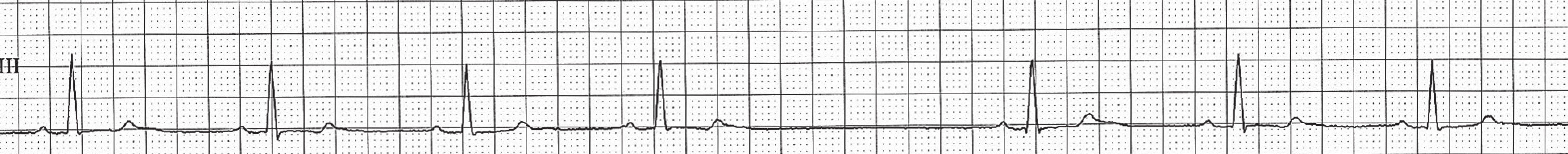 Pauza při dysfunkci SA uzlu (SA blokáda 2. stupně). Po čtrtém QRS komplexu následuje pauza, v rámci níž není přítomna
nepřevedená P vlna, a v tomto případě se jedná o pauzu na pokladě dysfunkce SA uzlu.
