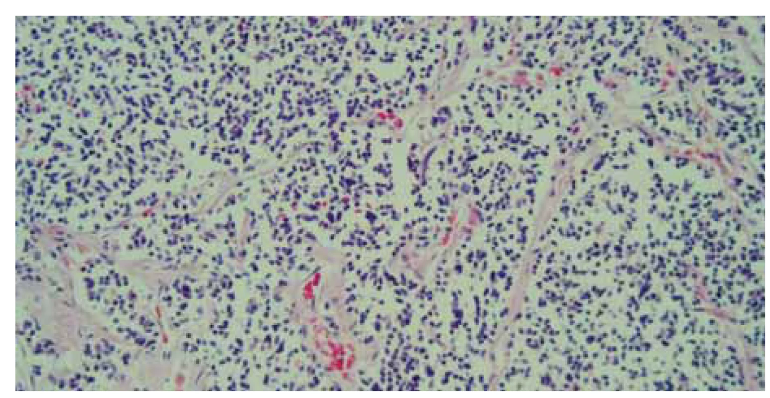 Histológia – parenchým pečene infi ltrovaný malobunkovou nádorovou
proliferáciou, farbenie hematoxylin-eozinom, zväčšenie 40×.<br>
Fig. 7. Histology – liver parenchyma infi ltrated by small cell tumour proliferation,
hematoxylin eosin staining, magnifi cation 40×.