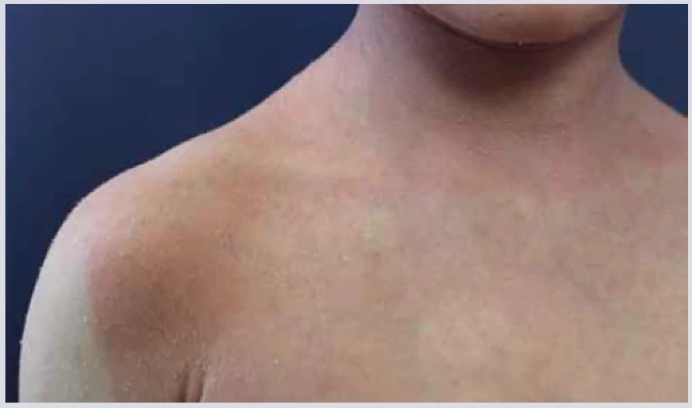 Ekzém. <br> 
Fig. 2. Eczema.