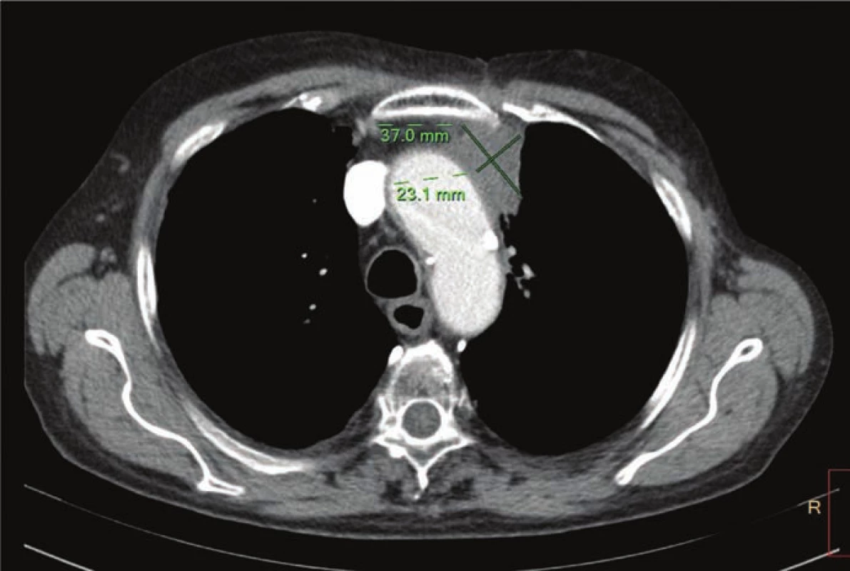 CT hrudníku a břicha z 10. 2. 2016 po čtyřech aplikacích nivolumabu – regrese
patologického ložiska v hrudníku.