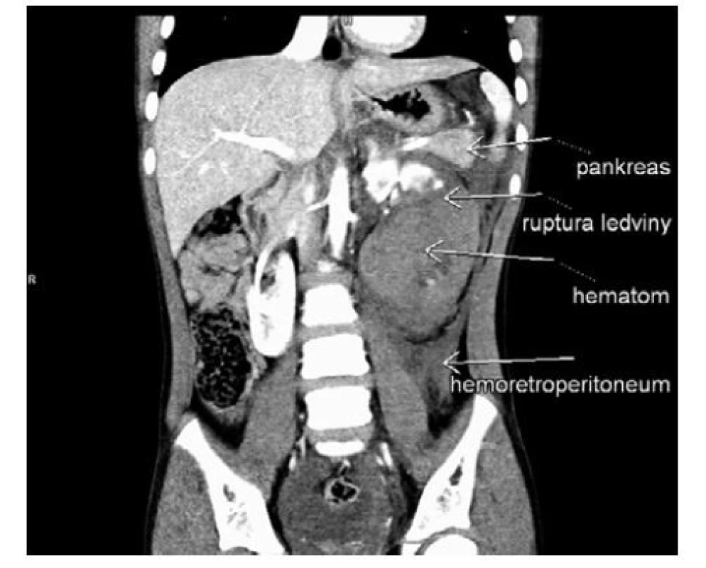 Ruptura levé ledviny s objemným hematomem
a aktivním leakem kontrastní látky po pádu
na schodech (AAST klasifikace IV), sdružené poranění
kaudy pankreatu, hemoperitoneum, pro oběhovou
nestabilitu akutní revize a nefrektomie<br>
Fig. 6. Rupture of left kidney with bulky hematoma
and active leak of contrast agent after falling on stairs
(AAST classification IV), associated injury of pancreatic
cauda, hemoperitoneum, for hemodynamic instability
acute revision and nephrectomy