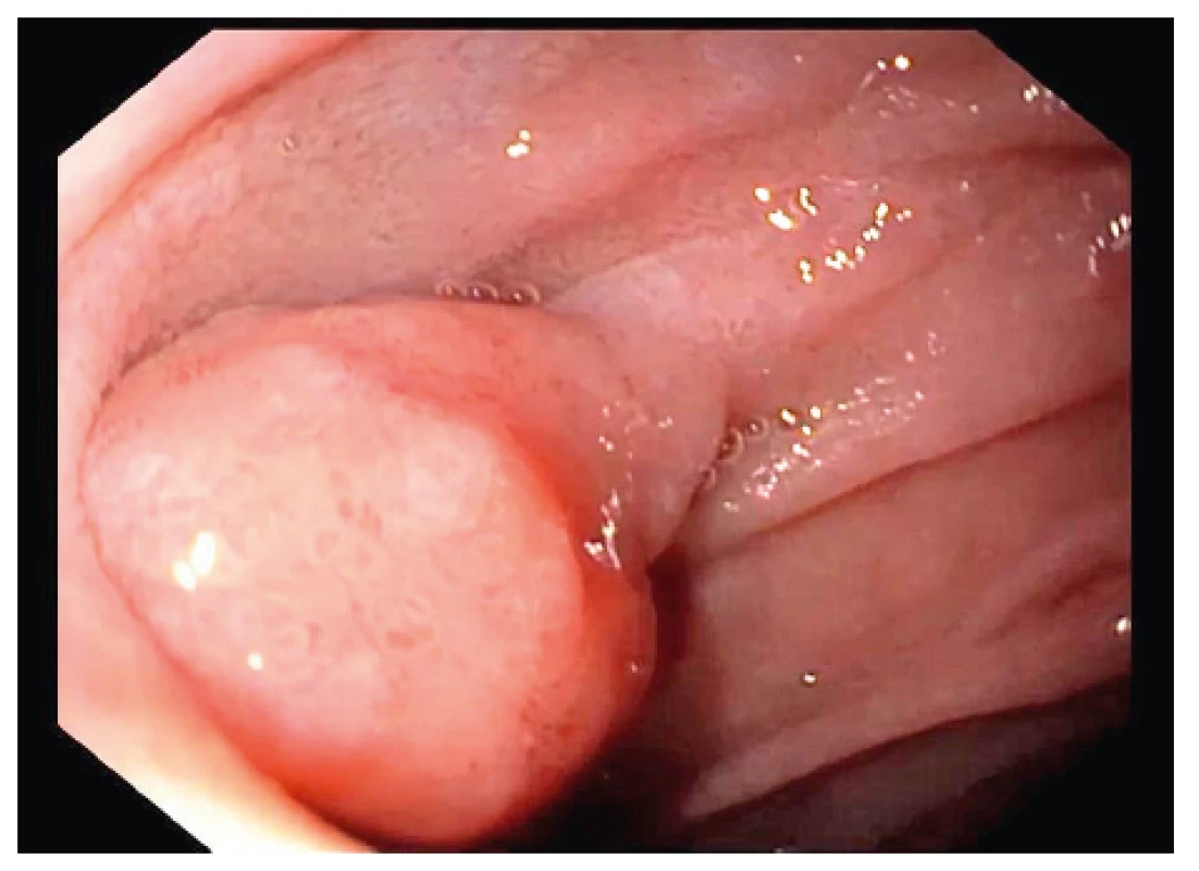 Polyp duodena