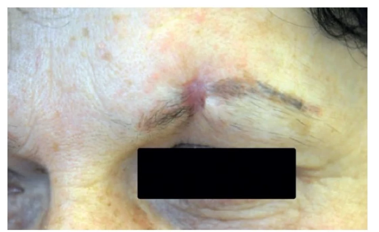 Stav po spontánním zhojení per secundam intentionem<br>
Fig. 2: Condition after spontaneous healing per secundam
intentionem