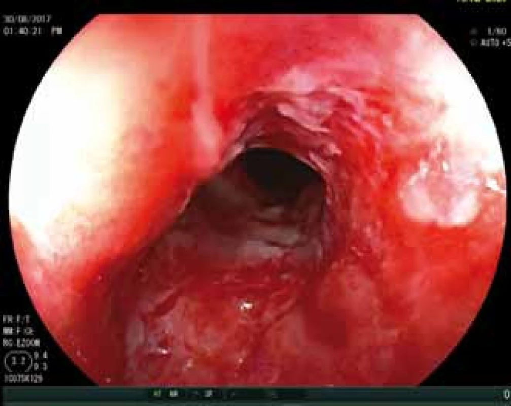 Stav po dilataci rekta po zahájení
léčby ustekinumabem.<br>
Fig. 2. Dilatation of rectum after initiation
of treatment with ustekinumab.