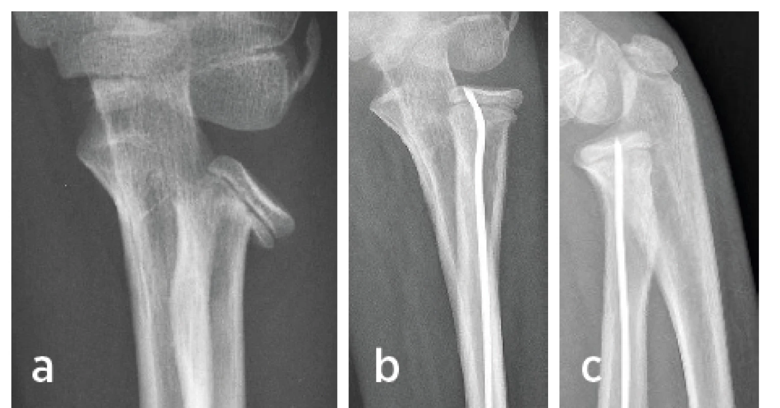 Dívka 9 let, separace proximální epifýzy radia
2. Salterova typu; a) úrazový RTG snímek v AP projekci
– posun fragmentu hlavice do 3 stupně dle Judeta;
b), c) po osteosyntéze v anatomickém postavení jak
v AP, tak bočné projekci.<br>
Fig. 3. Girl 9-year-old, separation of the proximal radial epiphysis
of the 2nd type according to Salter’s schedule;
a) injury X-ray image in the PA projection – radial head
displacement of the 3rd degree according to Judet
schedule; b), c) X-ray images after osteosynthesis
show the anatomical radial head position in both PA
and lateral projections.