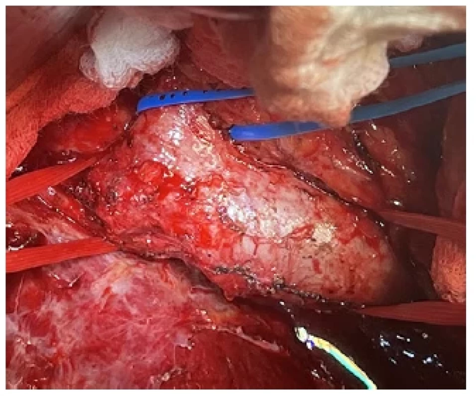 Kadaverózní allograft dolní duté žíly během
druhé operace <br> 
Fig. 2. Cadaveric allograft of the inferior vena cava
during second operation